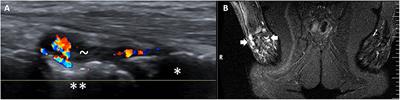 Whole-Body Magnetic Resonance Imaging Assessment of Joint Inflammation in Rheumatoid Arthritis—Agreement With Ultrasonography and Clinical Evaluation